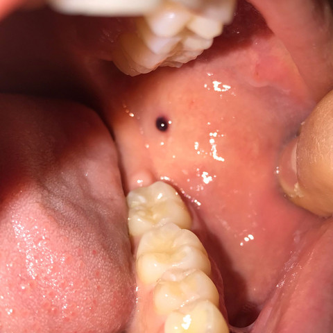 Schwarzer Punkt Im Mundraum Bekommen Was Ist Das Siehe Bild Gesundheit Und Medizin Gesundheit Medizin Schwarzer Punkt Im Mundraum Bekommen Was Ist Das Siehe Bild Gesundheit Und Medizin Gesundheit Medizin