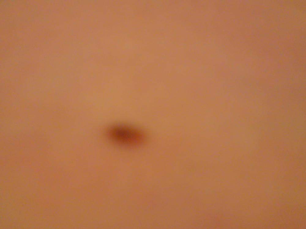 Schwarzer Punkt Im Muttermal Was Ist Das Krankheit Schwarz Punkte Schwarzer Punkt Im Muttermal Was Ist Das Krankheit Schwarz Punkte