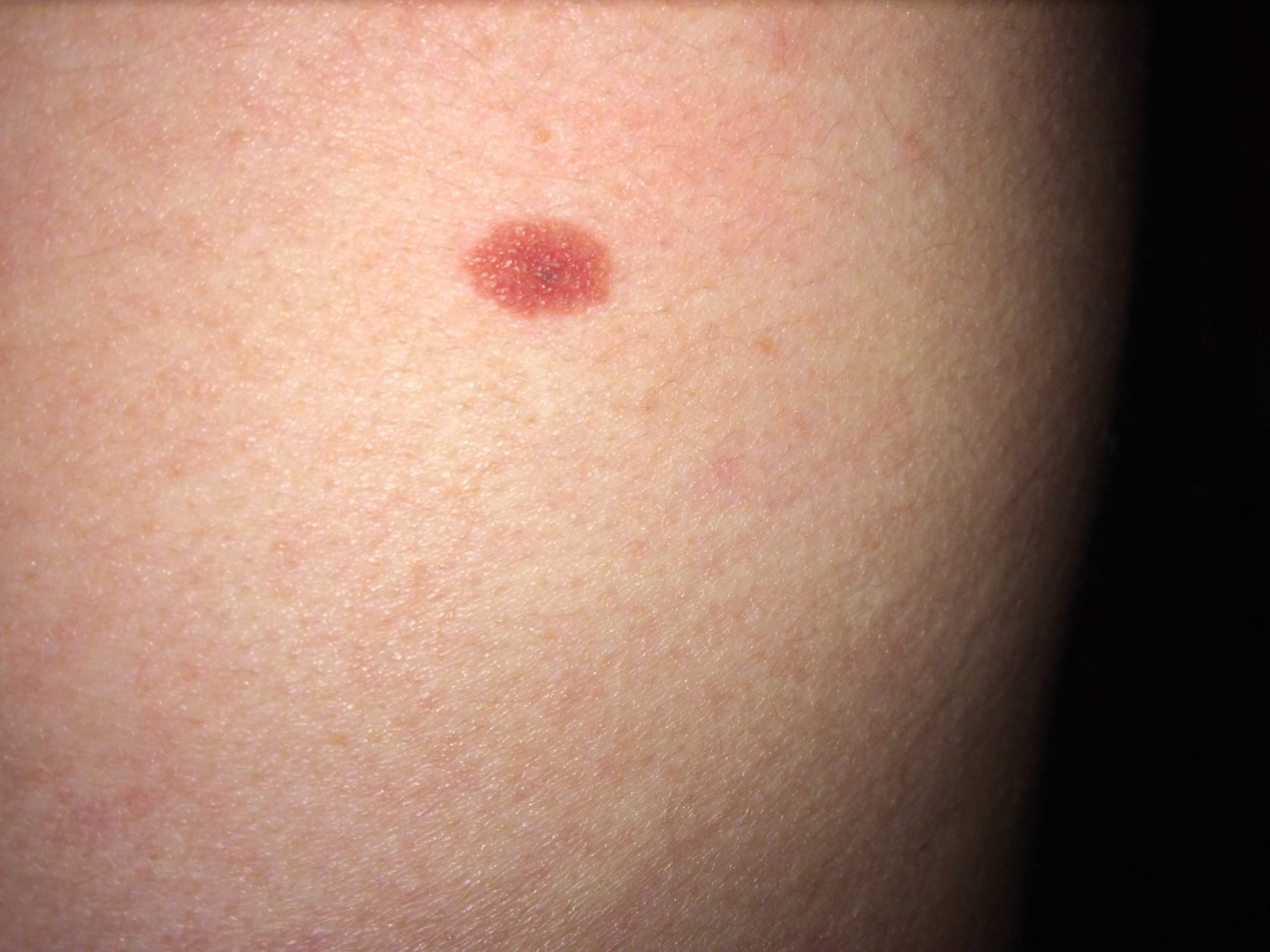 Schwarzer Punkt im Muttermal gefährlich? (Gesundheit, Krankheit, Haut)