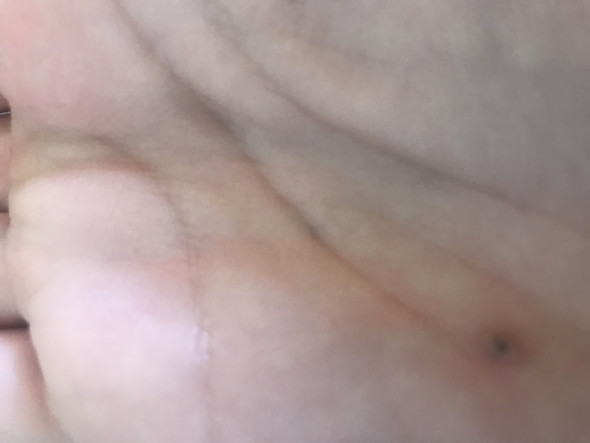 Schwarzer Punkt In Einer Warze Gesundheit Warzen Schwarzer Punkt In Einer Warze Gesundheit Warzen