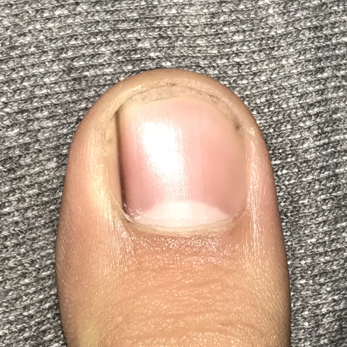 Schwarzer Strich im Nagel, was könnte es sein? (Medizin, Nägel)