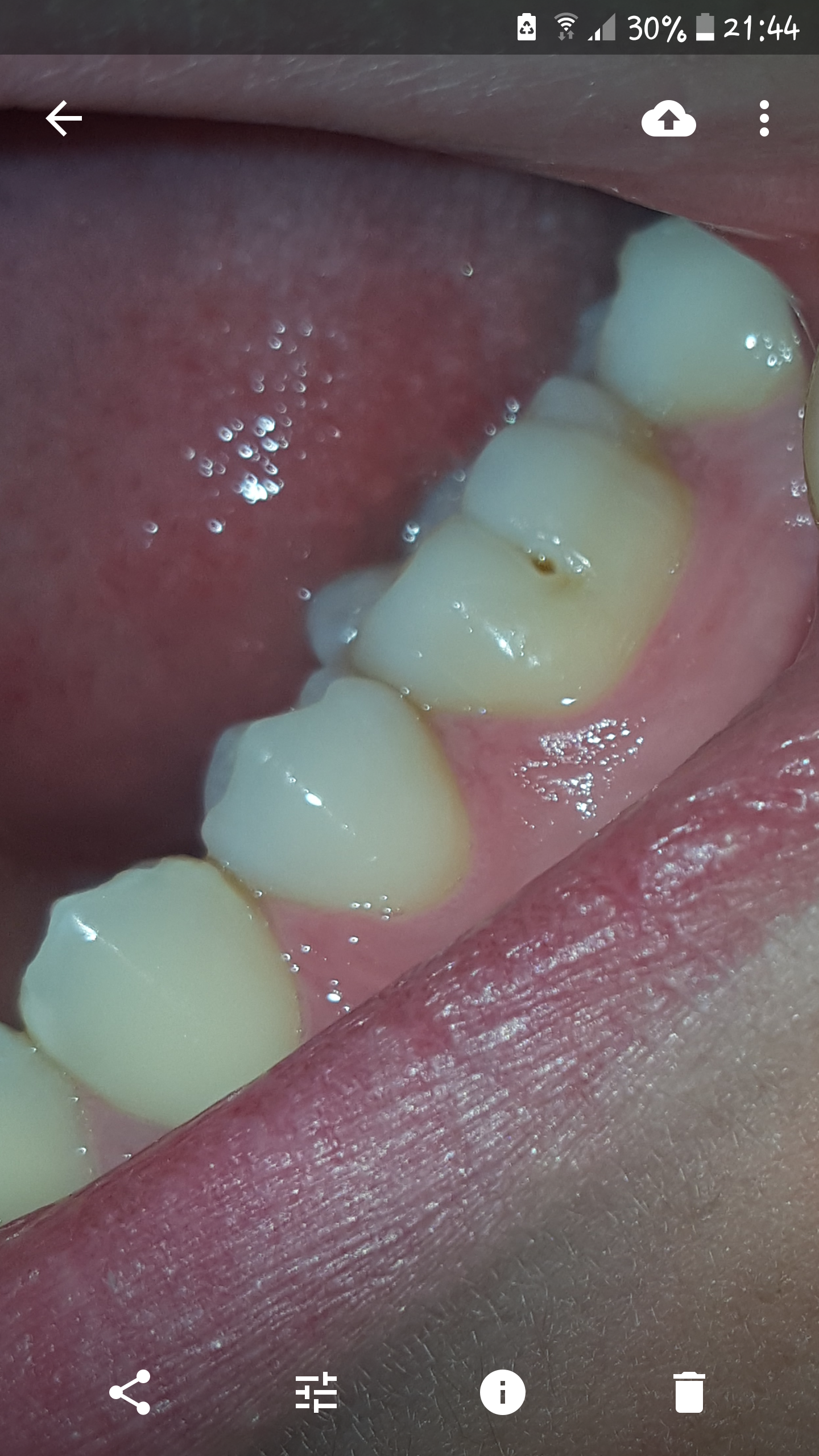 Schwarzes Loch An Meinem Backenzahn Zahne Zahnarzt Schwarzes Loch An Meinem Backenzahn Zahne Zahnarzt