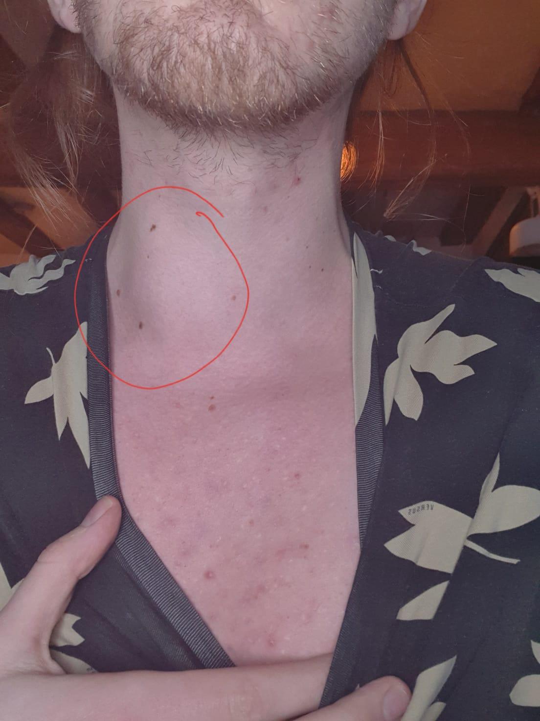 Schwellung Am Hals Links Was Kann Das Sein Gesundheit Und Medizin Gesundheit Medizin Schwellung Am Hals Links Was Kann Das Sein Gesundheit Und Medizin Gesundheit Medizin