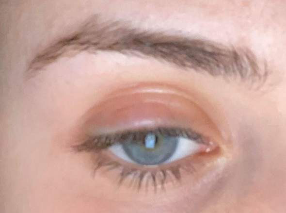 Schwellung Am Oberen Lid Medizin Korper Krankheit Schwellung Am Oberen Lid Medizin Korper Krankheit