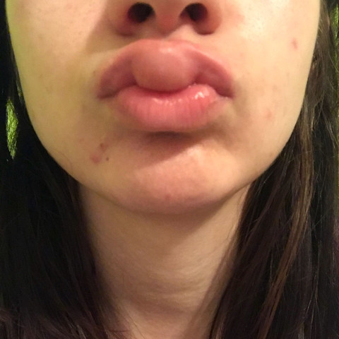 Schwellung Bzw Blase An Der Lippe Gesundheit Und Medizin Schwellung Bzw Blase An Der Lippe Gesundheit Und Medizin