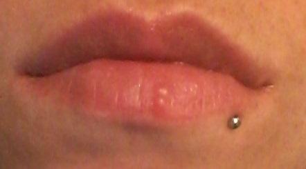herpes an der lippe bilder