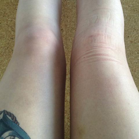 Schwellung im Knie die zweite :( (Schmerzen, Orthopäde, Chirurgie)