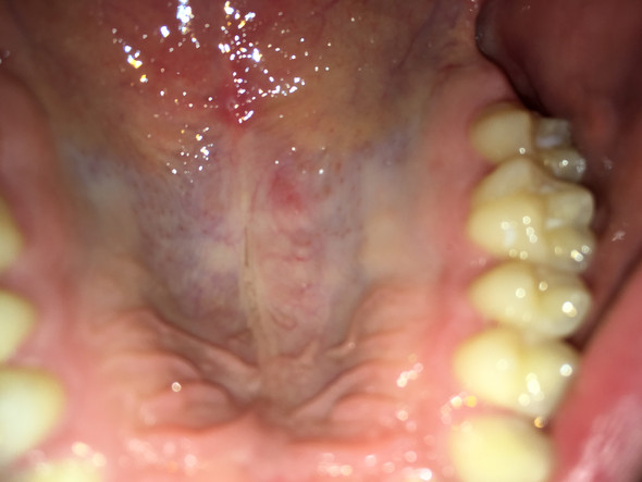Schwellung im Mundraum ? (Gesundheit und Medizin, Gaumen)