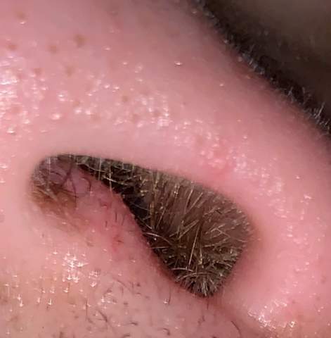 Schwellung In Der Nase Was Ist Das Gesundheit Und Medizin Haut Entzundung Schwellung In Der Nase Was Ist Das Gesundheit Und Medizin Haut Entzundung