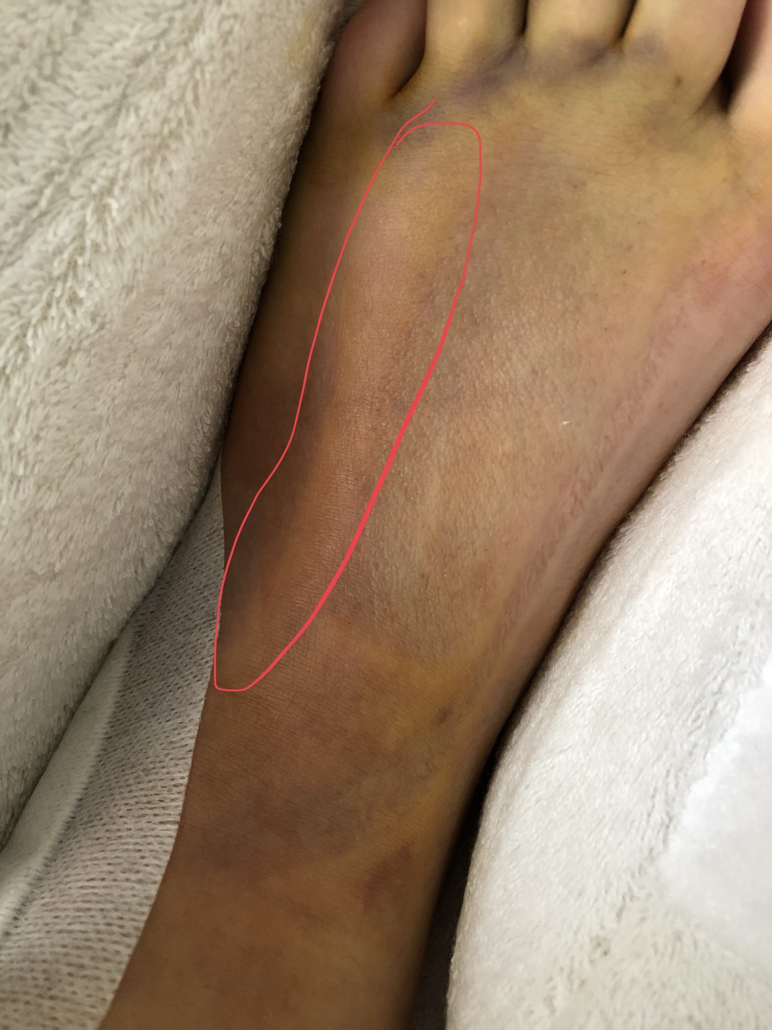 Schwellung Nach Op Am Sprunggelenk Gesundheit Und Medizin Operation Orthopadie Schwellung Nach Op Am Sprunggelenk Gesundheit Und Medizin Operation Orthopadie