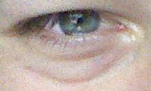 Augenschwellung - (Augen, Kosmetik, Augenringe)