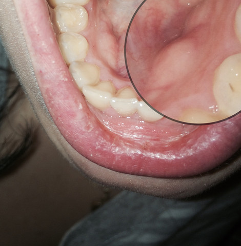 Schwellung Unter Der Zunge Wie Heisst Die Stelle Gesundheit Und Medizin Schwellung Unter Der Zunge Wie Heisst Die Stelle Gesundheit Und Medizin