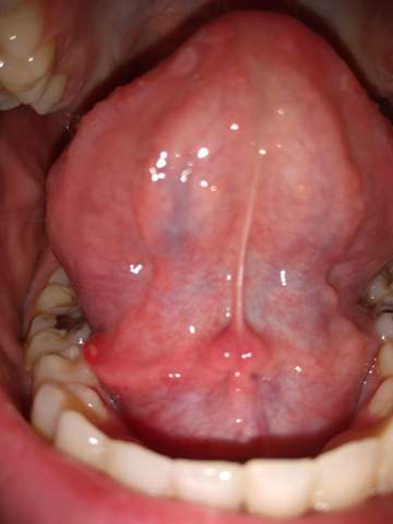 Schwellung Unter Zunge Was Ist Das Gesundheit Und Medizin Schwellung Unter Zunge Was Ist Das Gesundheit Und Medizin