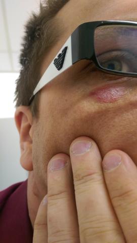 Schwellung Unterm Auge Was Is Das Entzundung Schwellung Unterm Auge Was Is Das Entzundung