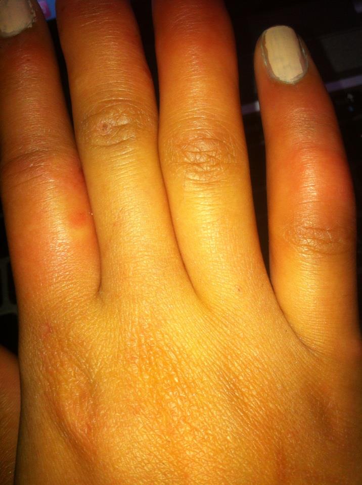 Schwellungen an den Fingern der Rechten Hand! was könnte das sein