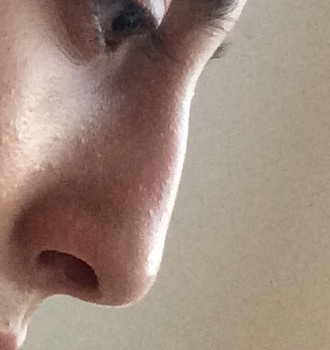 Schwellungen nach der Nasen Op? (Angst, Nerven, Nasen-OP)