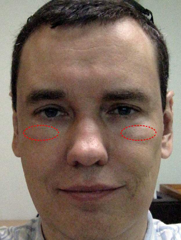 Schwellungen Unterm Auge Uber Dem Jochbein Medizin Arzt Augen Schwellungen Unterm Auge Uber Dem Jochbein Medizin Arzt Augen