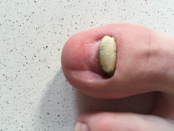 Schwerer Nagelpilz am großen Zeh… Wie Behandeln? (harnstoff) Schwerer Nagelpilz am großen Zeh… Wie Behandeln? (harnstoff)