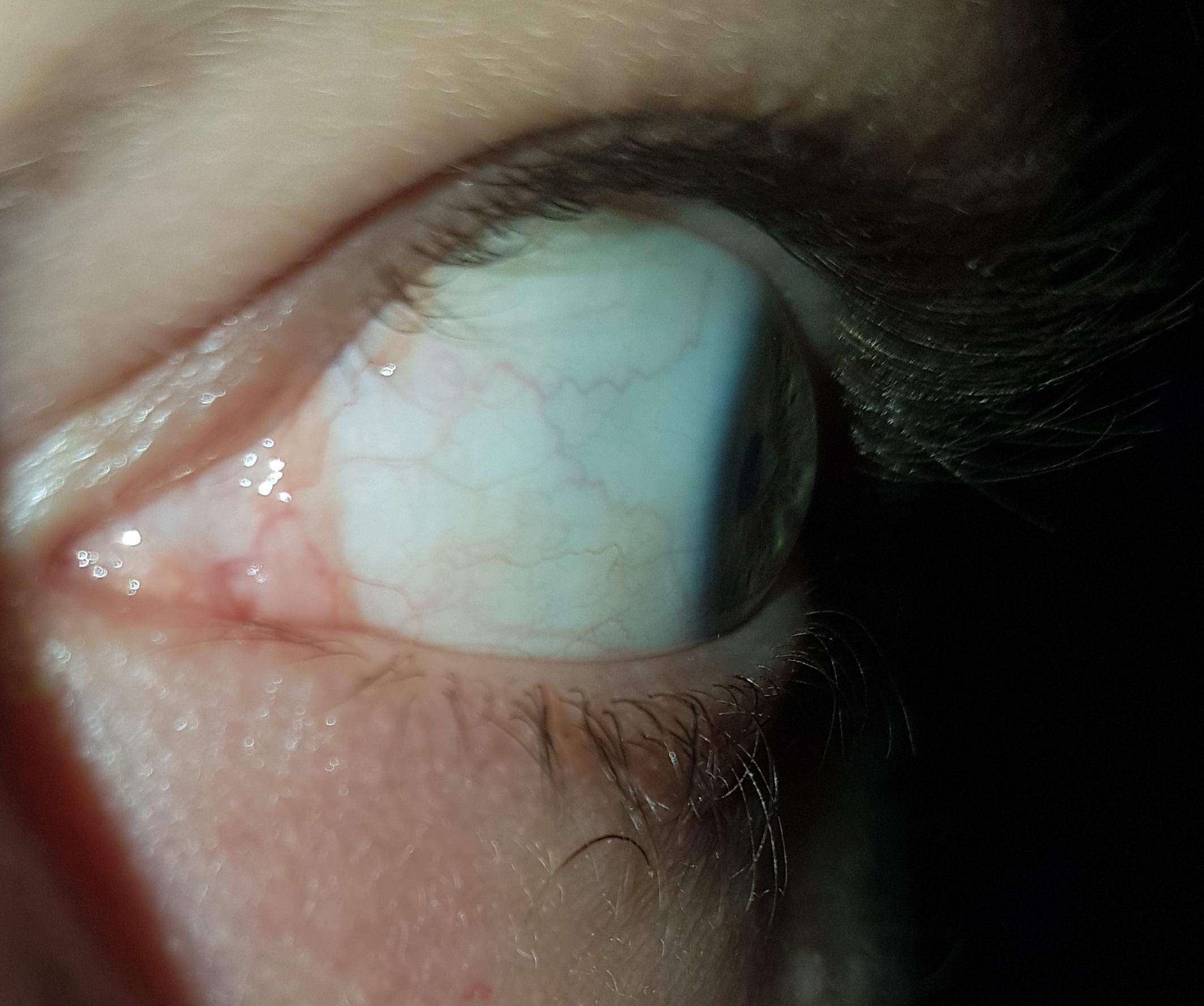 Sehen die Augen Normal aus Gelb? (Gesundheit und Medizin)