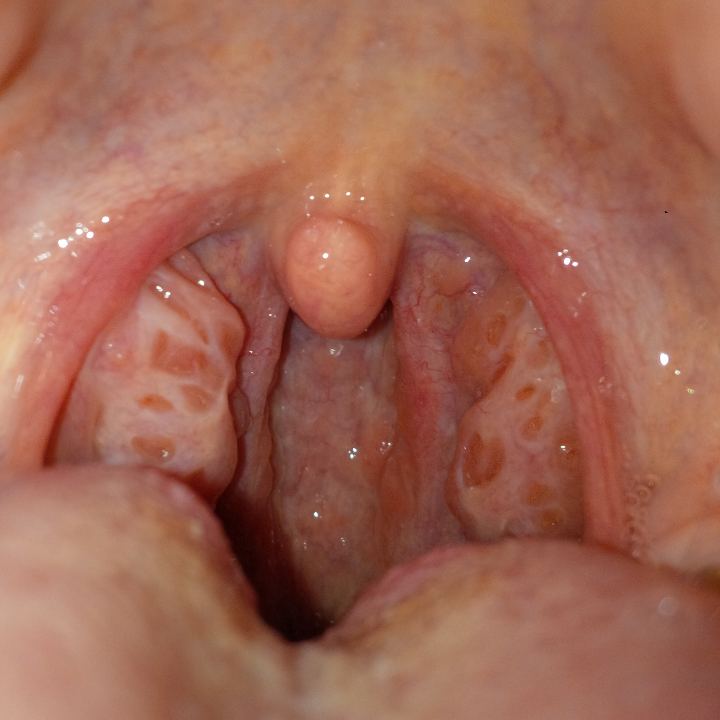 Sehen meine mandeln normal aus?! (Halsschmerzen, Rachen, kehlkopf) Sehen meine mandeln normal aus?! (Halsschmerzen, Rachen, kehlkopf)