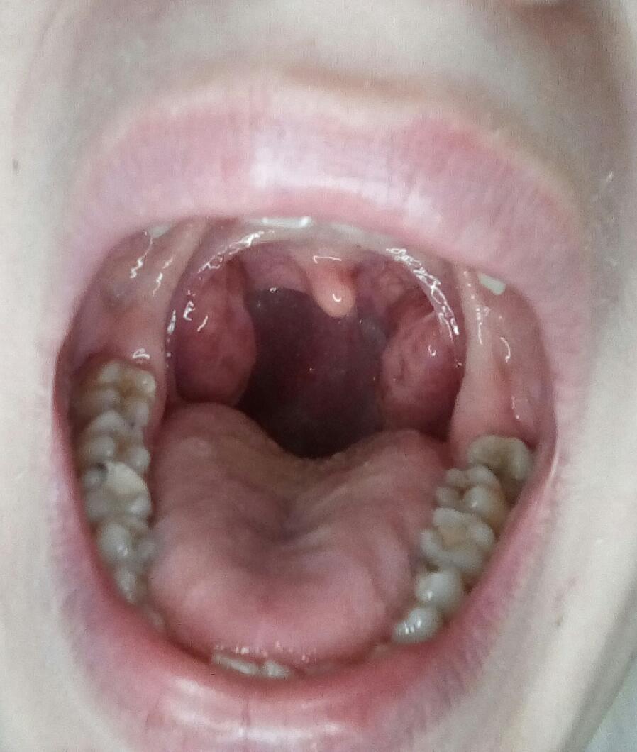 Sehen meine Mandeln zu groß aus? (Gesundheit und Medizin, Hals Sehen meine Mandeln zu groß aus? (Gesundheit und Medizin, Hals