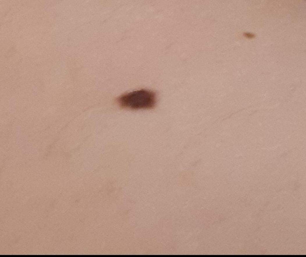 Sehen meine Muttermale noch ,,gesund" aus? (Hautarzt, Muttermal)