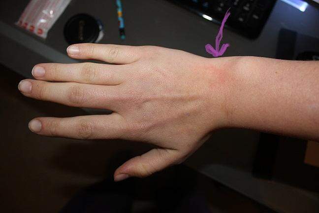 Voltaren sehnenscheidenentzündung 10 Behandlungsmethoden