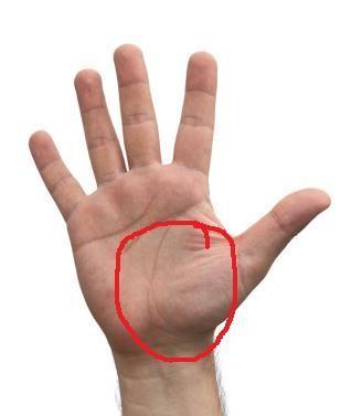 Gips hilft sehnenscheidenentzündung ein bei Gips bei