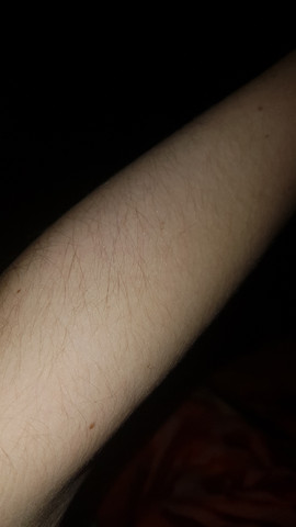 Sehr Behaarter Arm Als Frau Haare