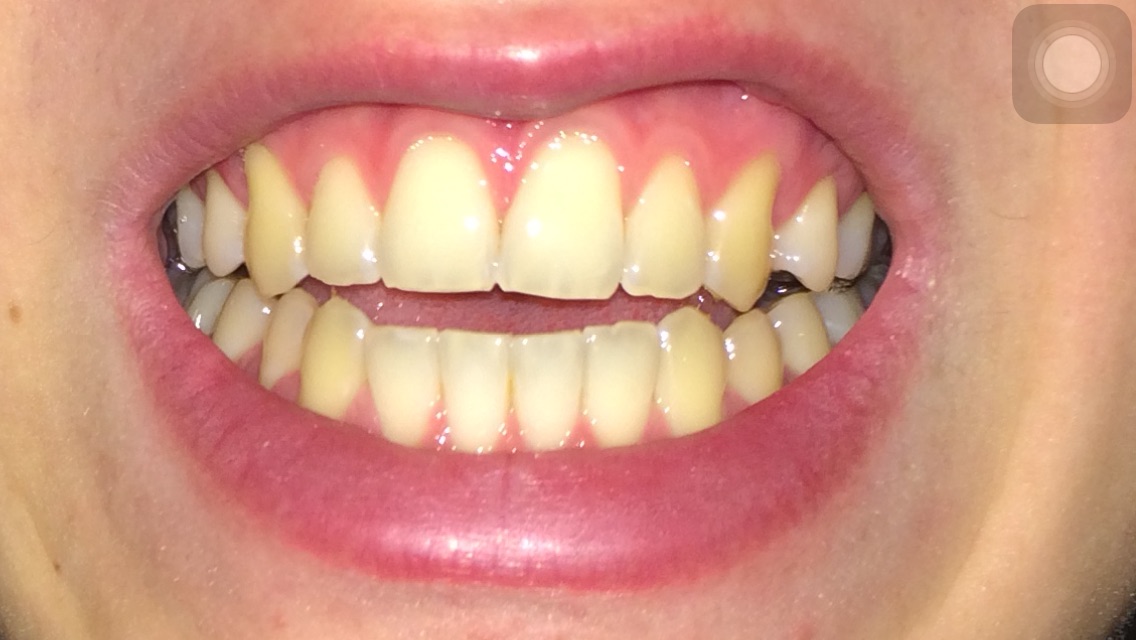 Gelber Zahn