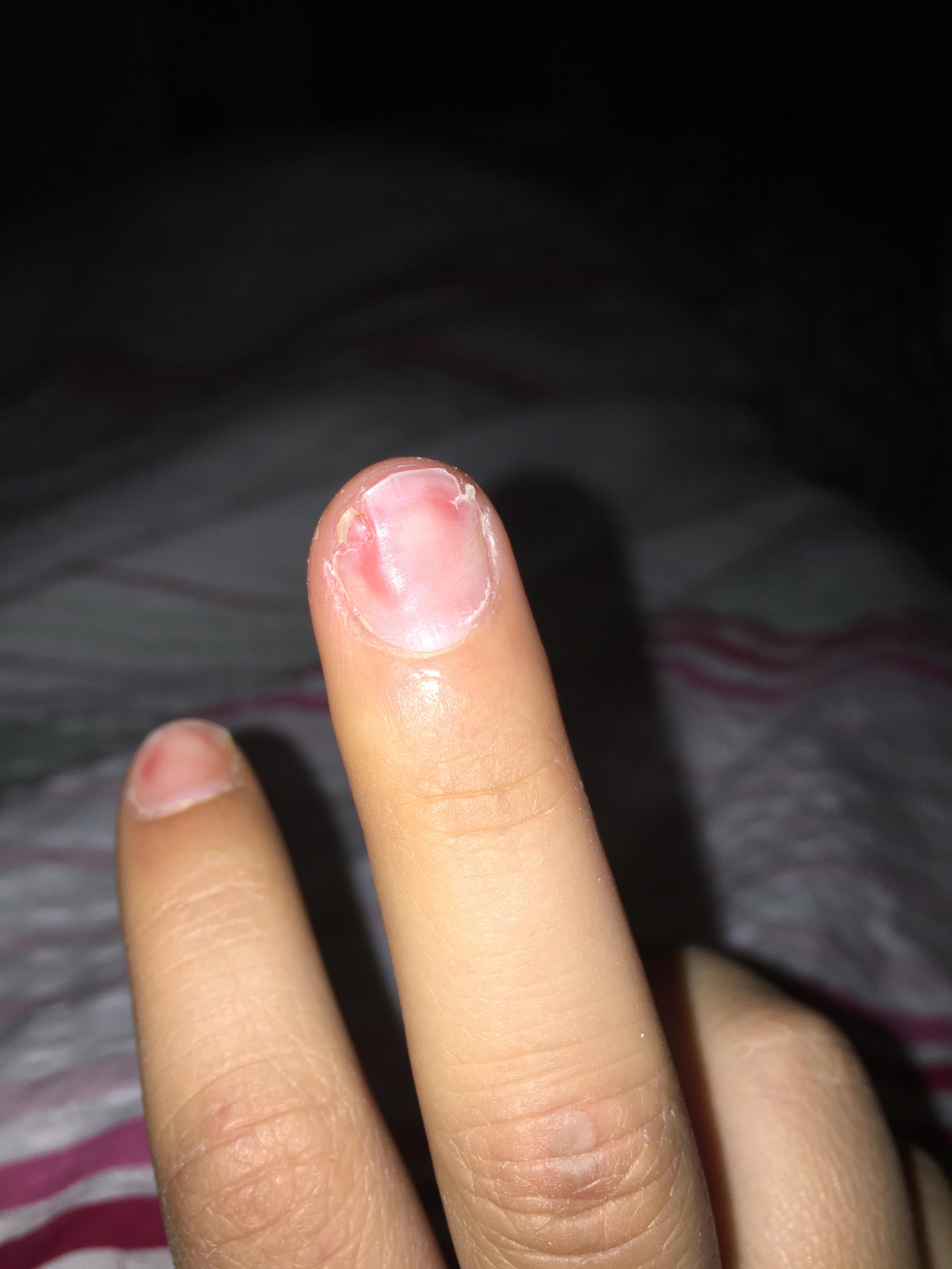 Sehr Kaputter Nagel Eingerissen Gesundheit Und Medizin Gesundheit Nagel Sehr Kaputter Nagel Eingerissen Gesundheit Und Medizin Gesundheit Nagel