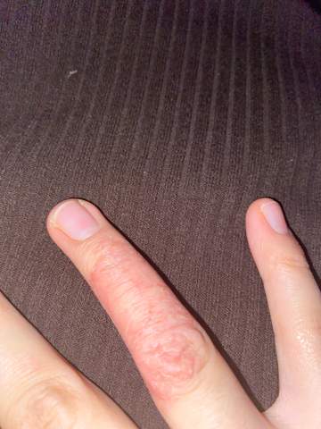 Sehr rissiger, trockener Ringfinger, die Haut sieht schuppig aus?