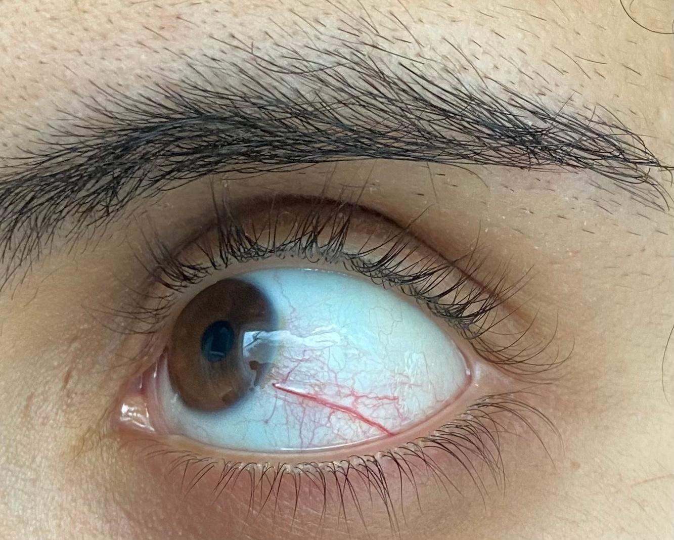 Sehr rote, gerötete Ader im linken Auge, ist das gefährlich? (Gesundheit und Medizin, Gesundheit