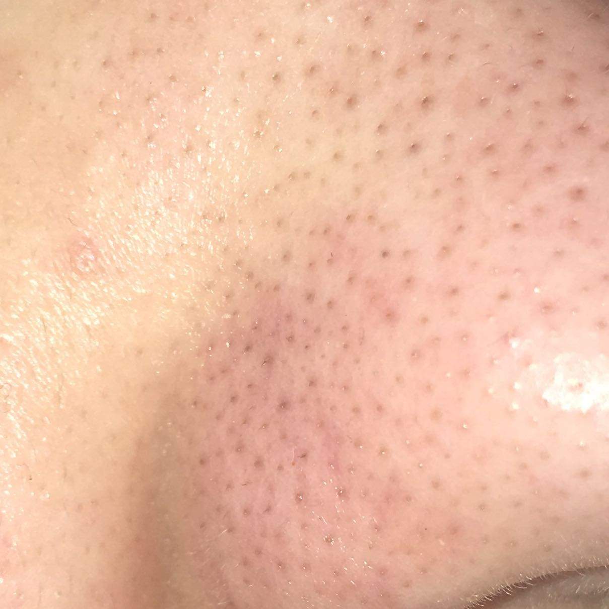 Sehr starke Mitesser auf der Nase? (Gesundheit und Medizin, Beauty, Pickel) Sehr starke Mitesser auf der Nase? (Gesundheit und Medizin, Beauty, Pickel)