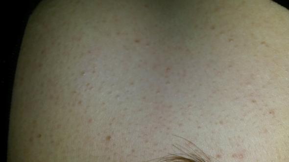 Sehr Unreine Haut Am Dekoltee Pickel Unreinheiten