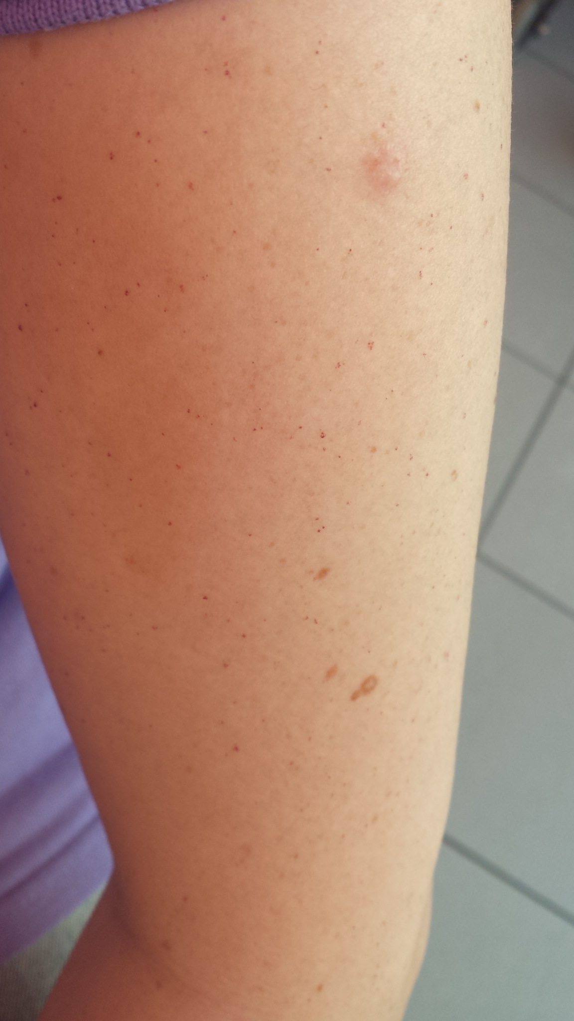 Sehr viele kleine rote Punkte / Blutpünktchen auf der Haut (Gesundheit