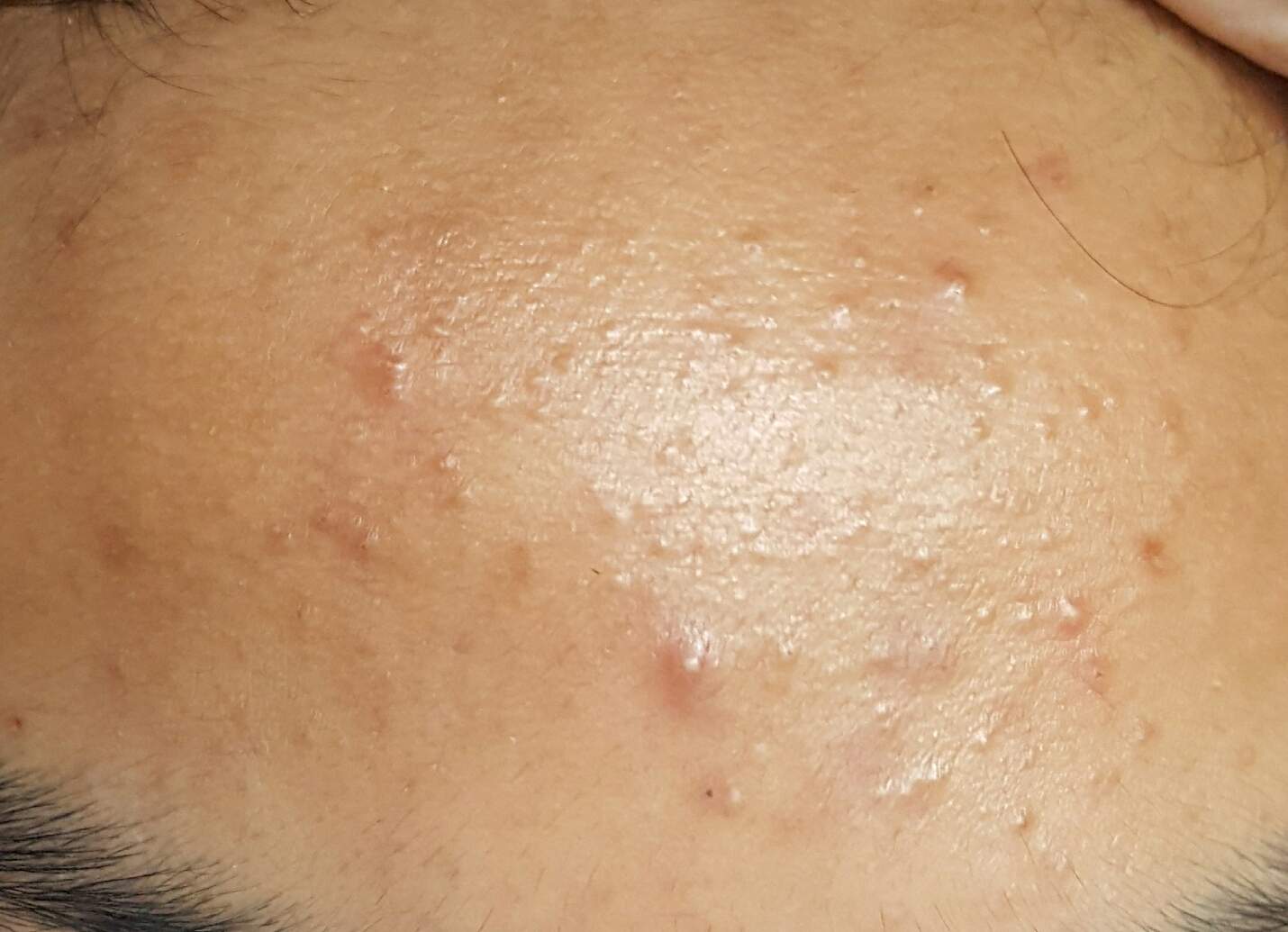 pickel in der vulva pickel in der vulva