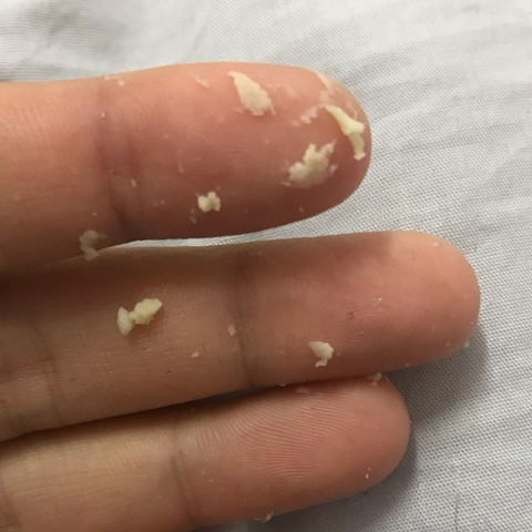 Seid Tagen Jucken Im Intim Berreich Eben Als Ich Mit Meiner Hand Da Gekratzt Habe Kam Das Was Kann Das Sein Eine Infektion Oder Pilzinfektion Habe So Angst Gesundheit Und Medizin Vagina Seid Tagen Jucken Im Intim Berreich Eben Als Ich Mit Meiner Hand Da Gekratzt Habe Kam Das Was Kann Das Sein Eine Infektion Oder Pilzinfektion Habe So Angst Gesundheit Und Medizin Vagina