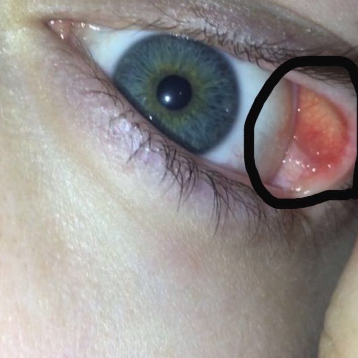 Warum Tut Mein Auge Weh Seit 5 tagen tut mir mein Auge dort sehr weh, fühlt sich an als wäre da