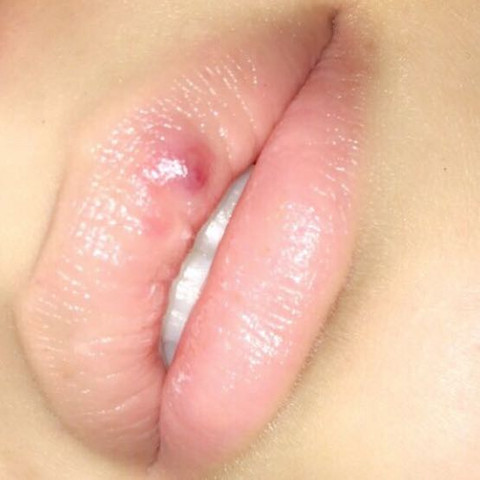 Seit 6 Jahren Etwas Auf Der Lippe Gesundheit Und Medizin Gesundheit Hamatom