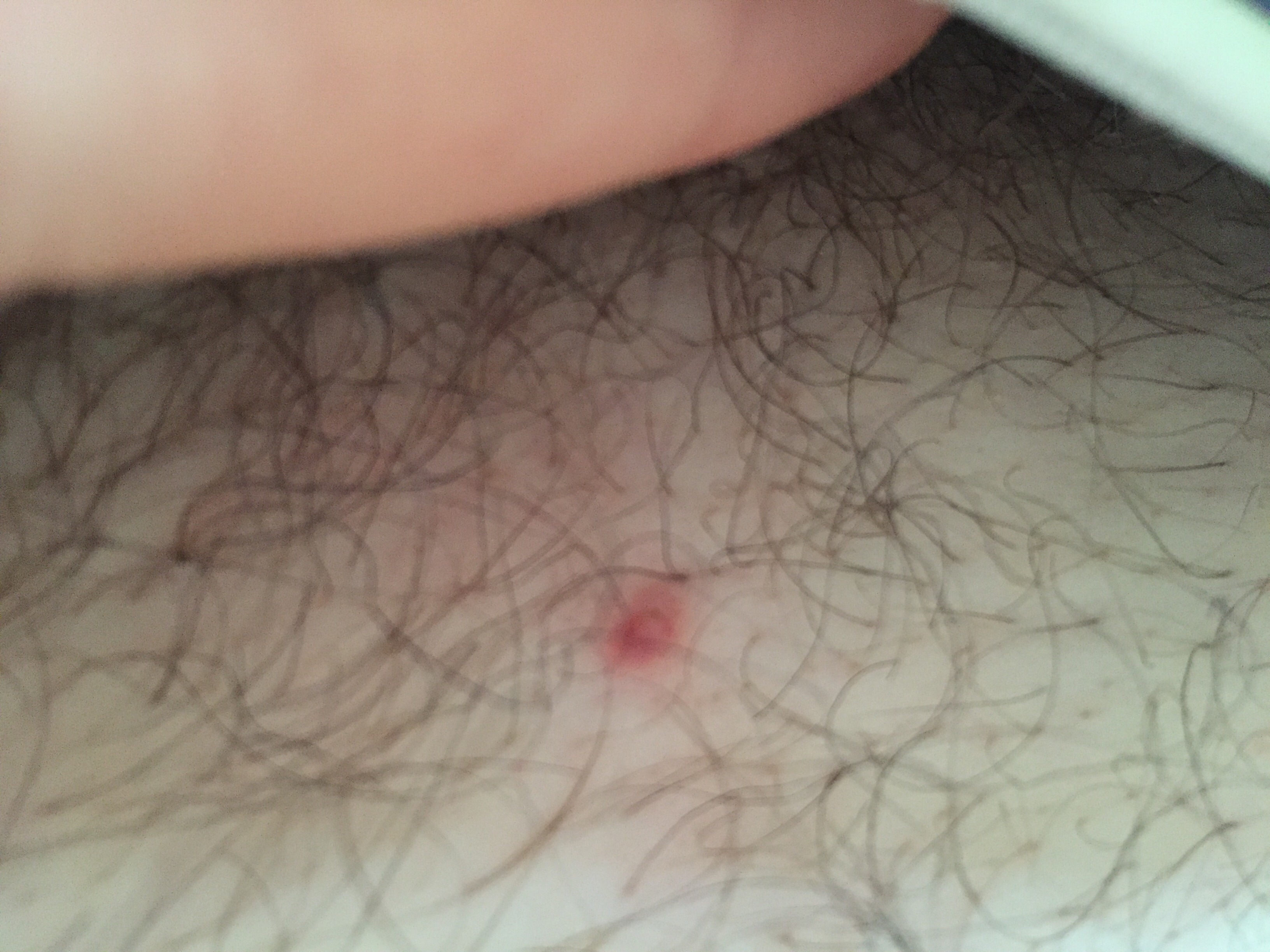 Im intimbereich pickel kleine Pickel an