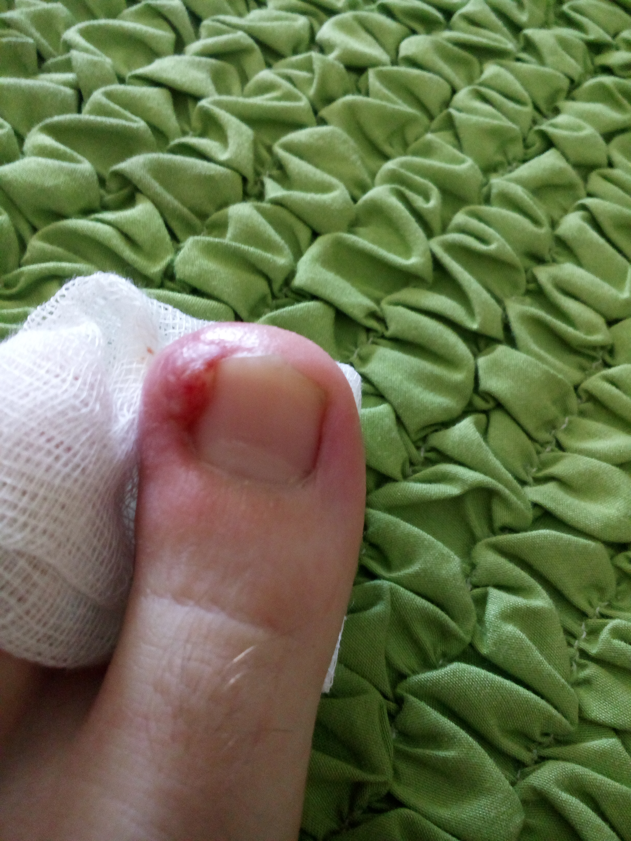 Seit Ca 2 Wochen Wildes Fleisch Am Zeh Wildes Fleisch Seit Ca 2 Wochen Wildes Fleisch Am Zeh Wildes Fleisch