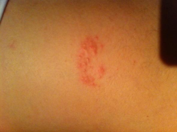 Seit Dem Solarium Komische Stelle Am Rucken Pickel Blaschen