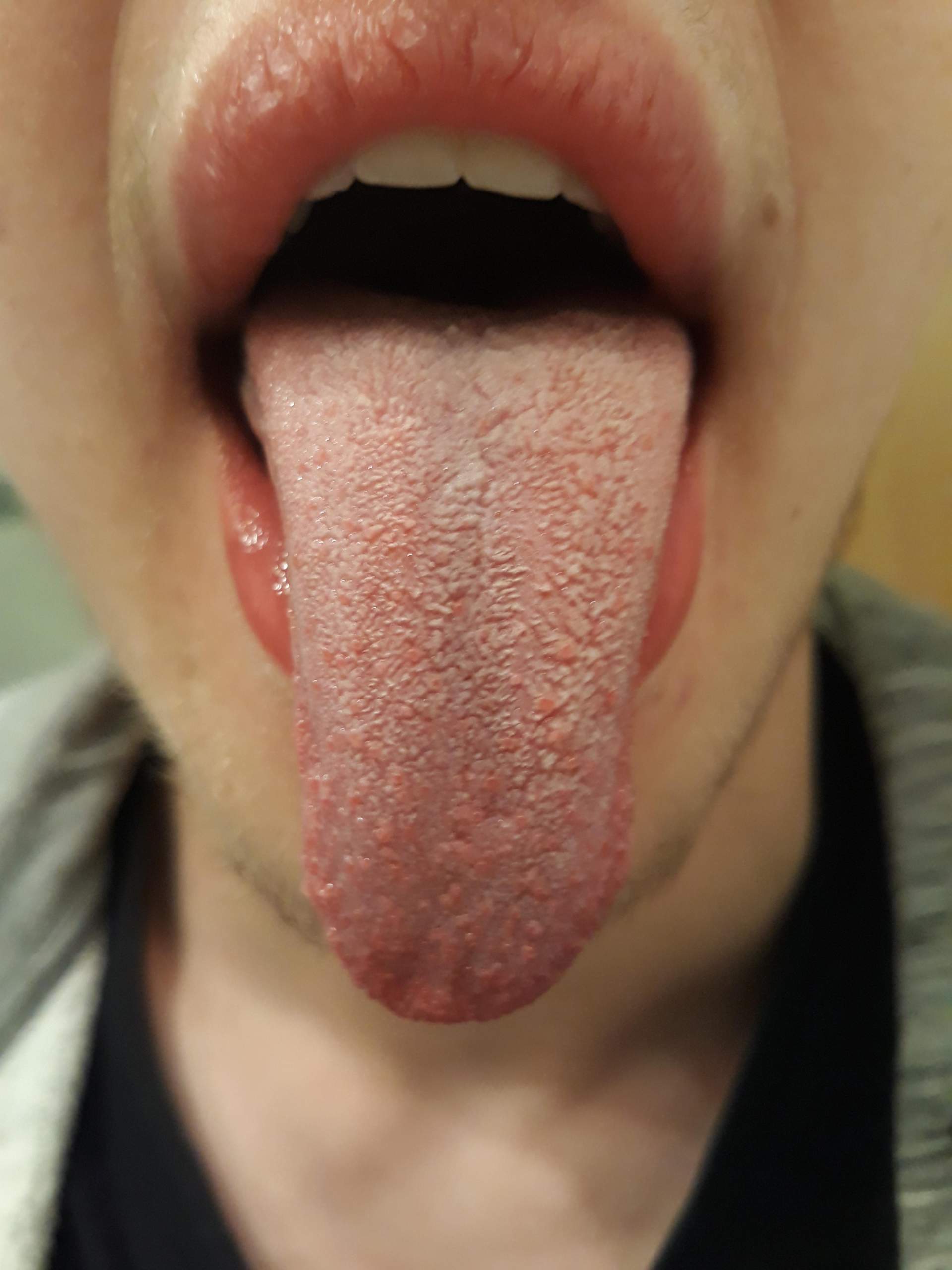 Seit einer Woche Weißer Belag auf der Zunge? (Gesundheit und Medizin, Gesundheit, Mund) Seit einer Woche Weißer Belag auf der Zunge? (Gesundheit und Medizin, Gesundheit, Mund)