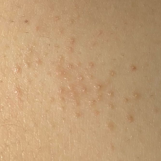 Seit einigen Tagen kleine Pickelchen. Was ist das. Hatte das jemand schon mal? (Pickel, Brüste pickel auf brust