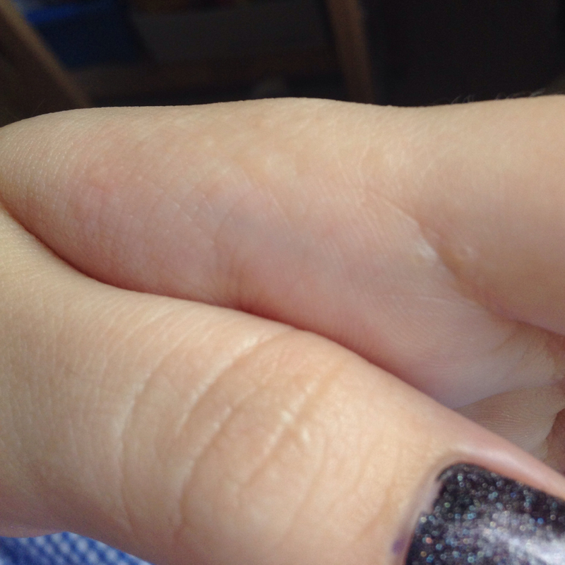 Seit heute Bläschen auf der Hand (Hautkrankheit, blaeschen) Seit heute Bläschen auf der Hand (Hautkrankheit, blaeschen)