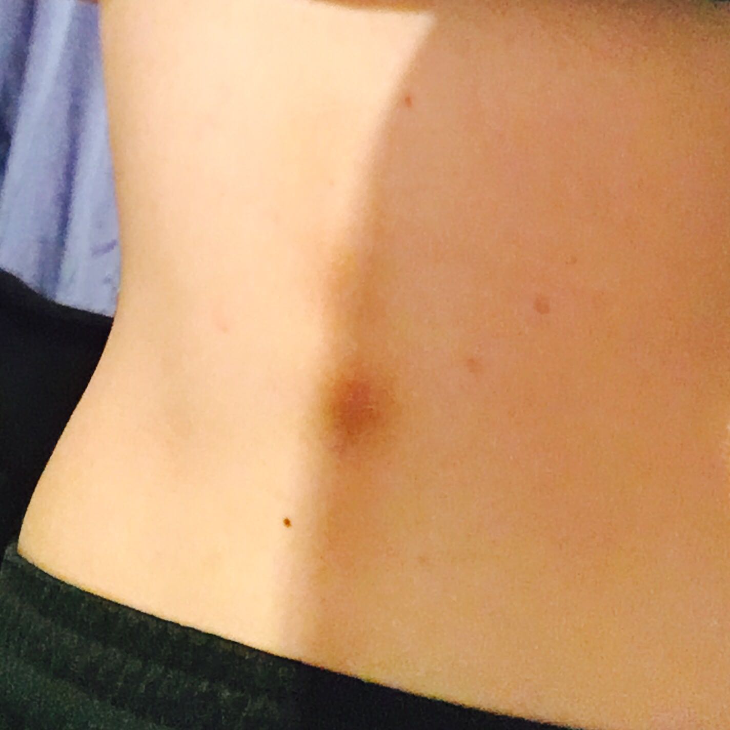 seit jahren dunklerer fleck an der wirbelsäule der jetzt angefangen hat zu schmerzen was ist das pickel an der wirbelsäule