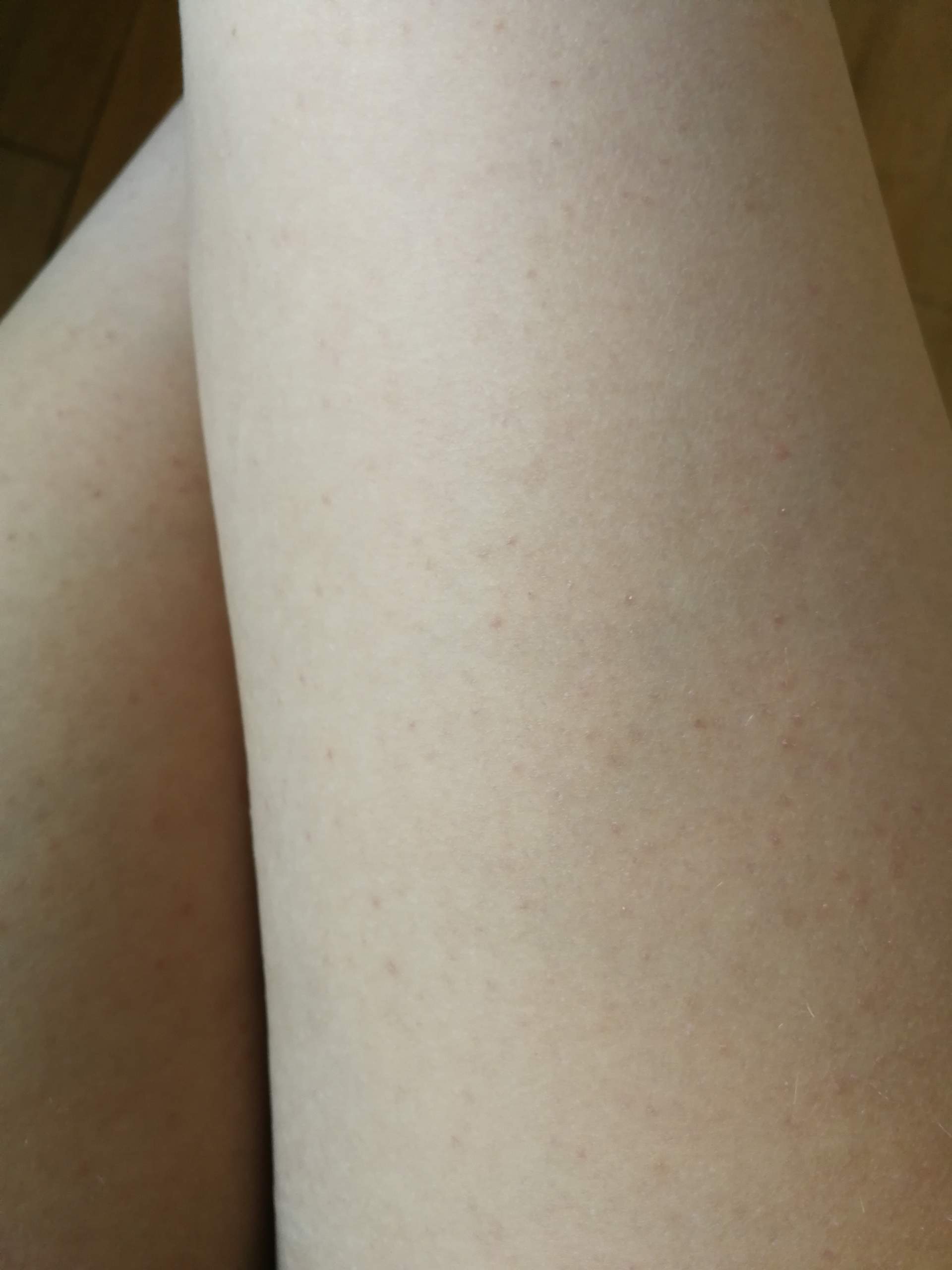 Seit Jahren Pickel an den Beinen wie gehen die weg? (Beauty, Beine, glatt)