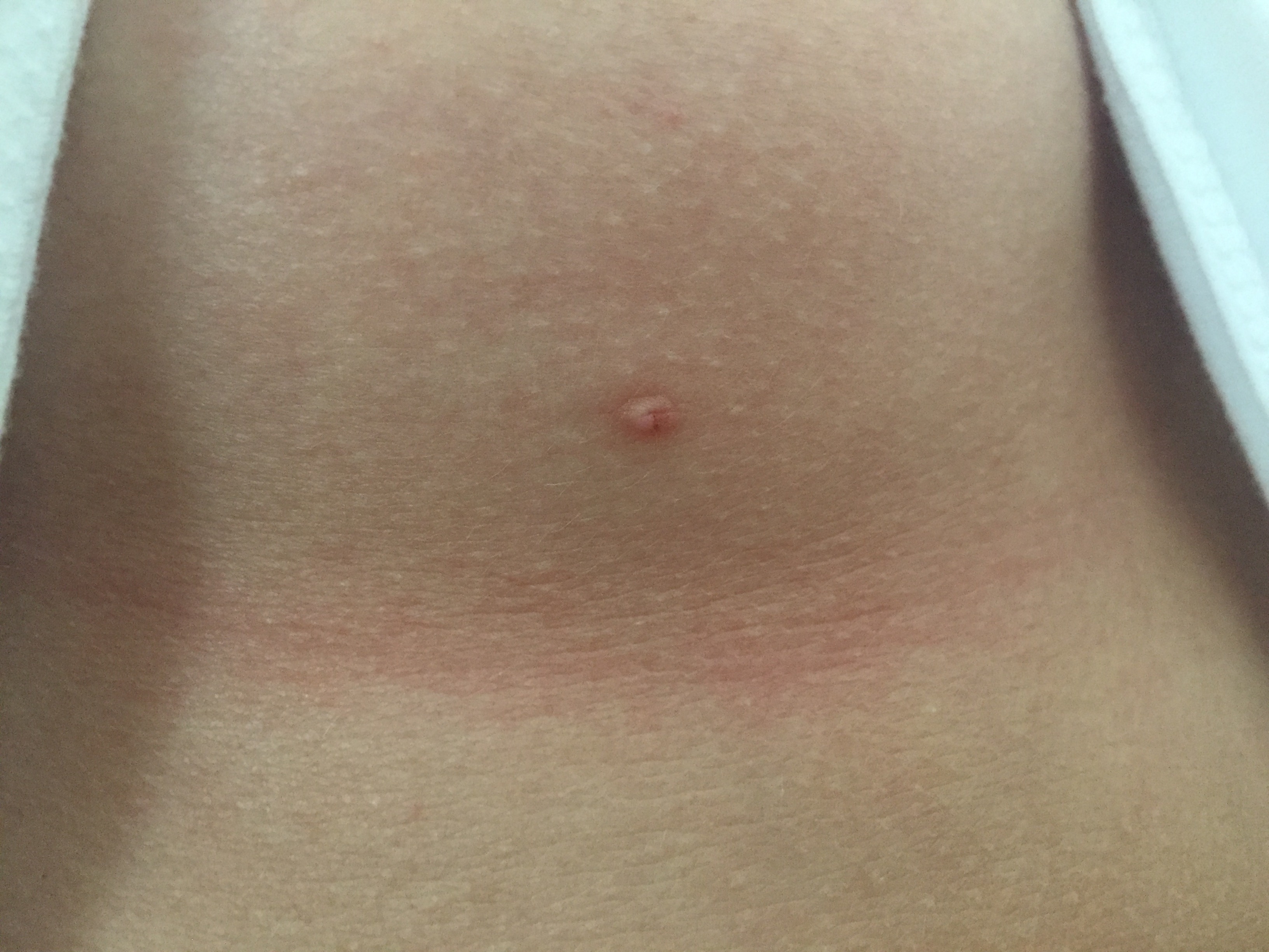 seit jahren pickel mit loch unter brust (+FOTOS), was ist das? (Haut seit jahren pickel mit loch unter brust (+FOTOS), was ist das? (Haut