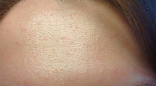 Bild der betroffenen Stelle - (Haut, Hautpflege, unreine Haut)